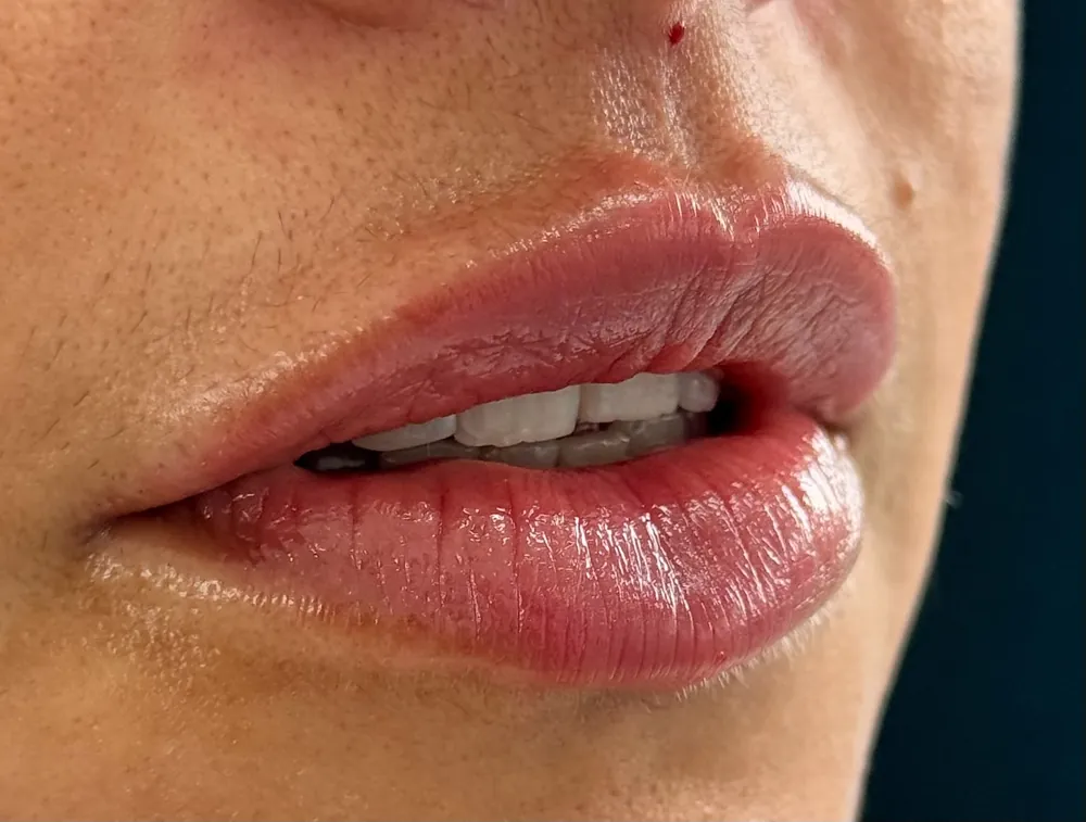 Lábios com preenchimento labial de aspecto natural