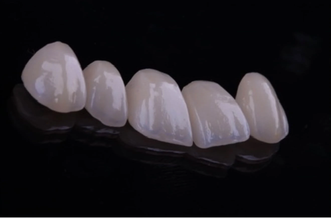 Facetas em porcelana feitas na Reference, sobre fundo preto